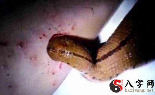 梦到大腿有水蛭