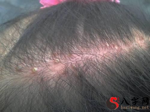 梦到头上有臭虫