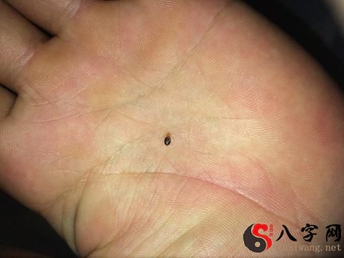 梦到吸血虫咬自己