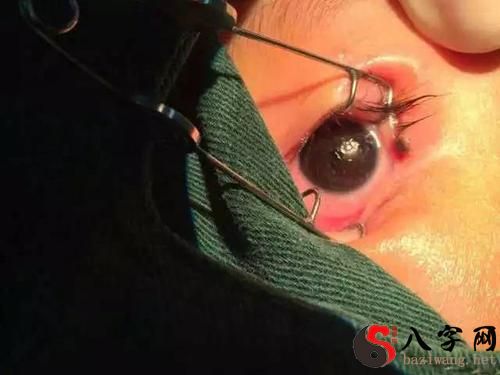 梦到眼睛有虫子