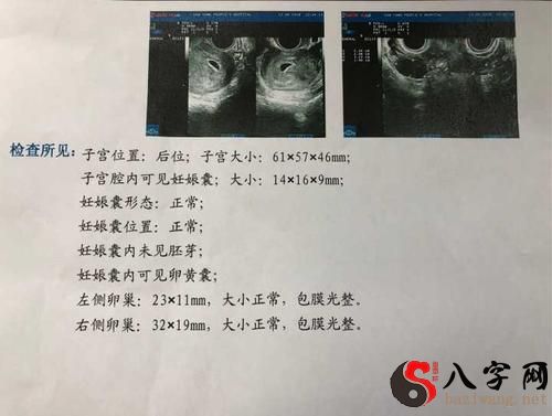梦到自己怀孕做流产