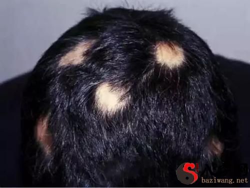 梦到头发掉秃一块